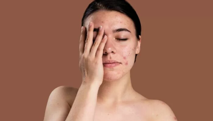 Cara Mengatasi Jerawat Dengan Skincare Yang Tepat