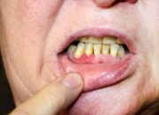 Pengaruh Gigi Goyang Pada Kesehatan Mulut