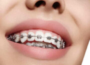 Perawatan Gigi Saat Menggunakan Behel (Braces)