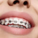 Perawatan Gigi Saat Menggunakan Behel (Braces)