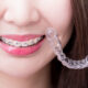 Perawatan Gigi Saat Menggunakan Retainer